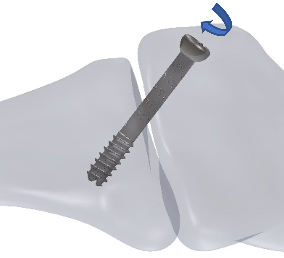 Step One Is to Insert ActivOrtho Implant